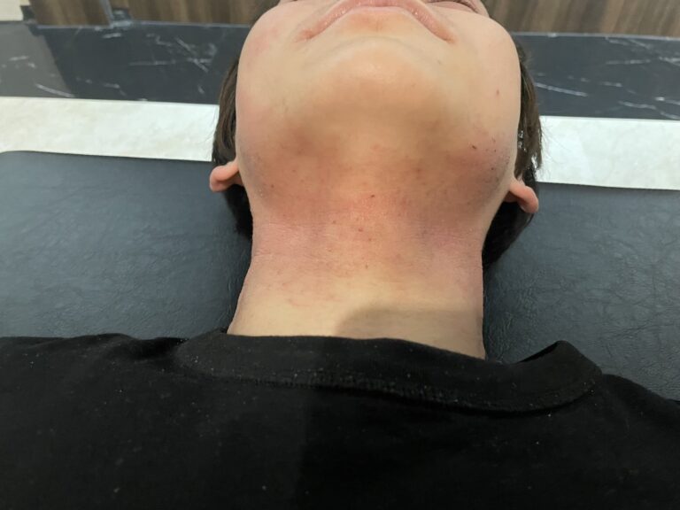 １回目施術前のアトピー患者様の首の写真