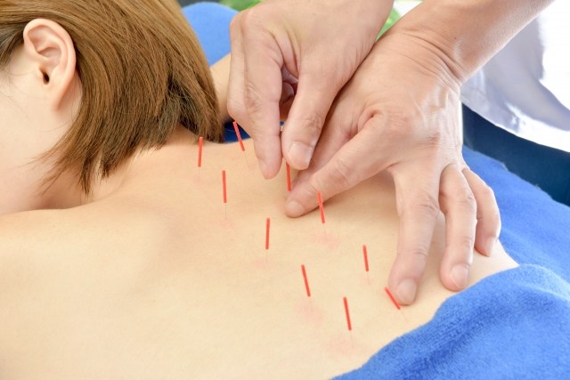 鍼施術を受けている女性の写真