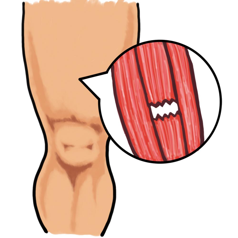 肉離れした筋肉のイラスト