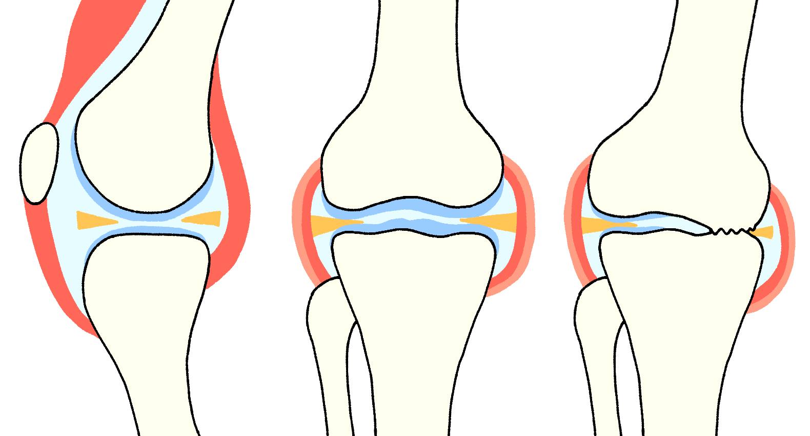 変形性膝関節症のイラスト