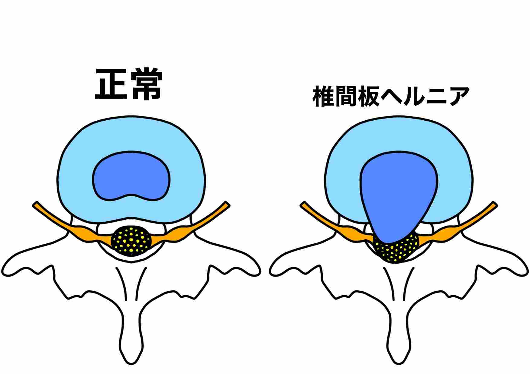 椎間板ヘルニアのイラスト