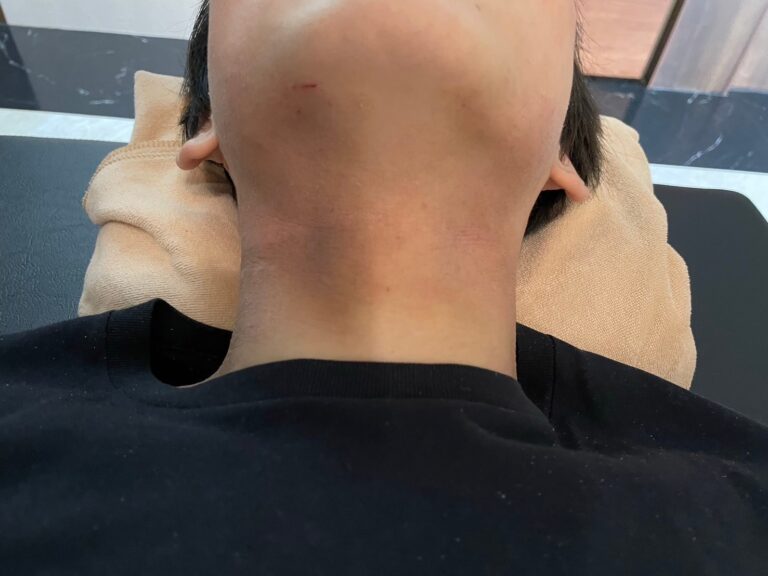 4回目施術前のアトピー患者様の首の写真