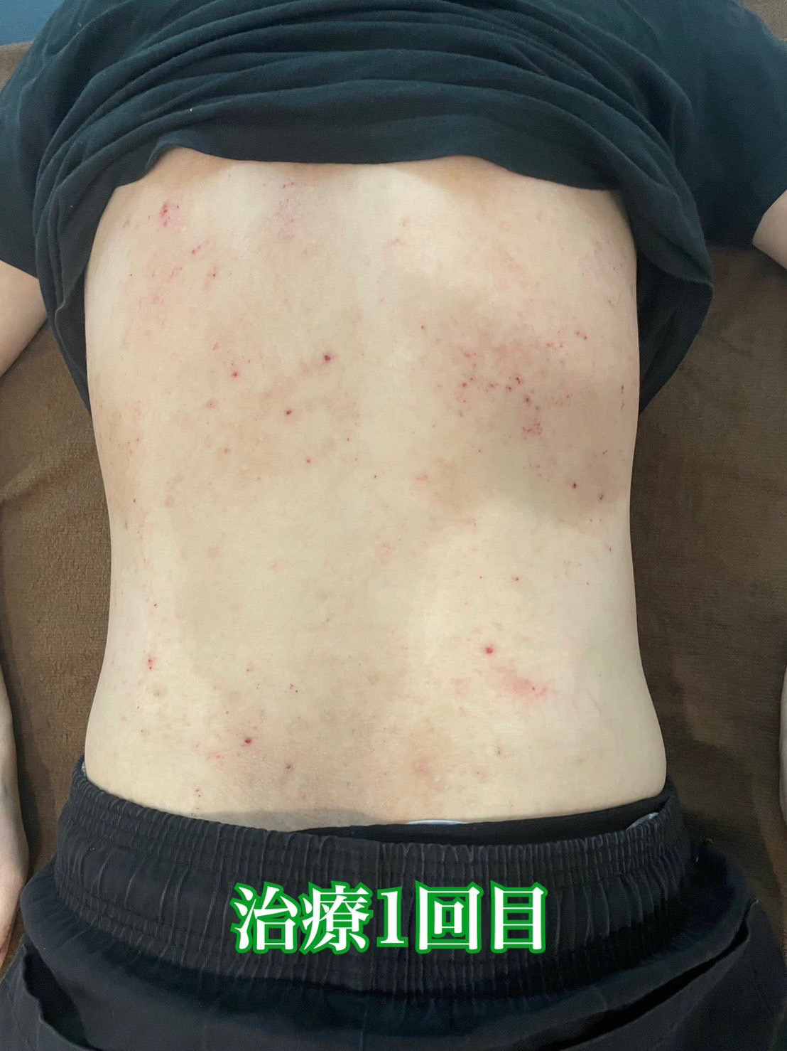 １回目施術前のアトピー患者様の背中の写真