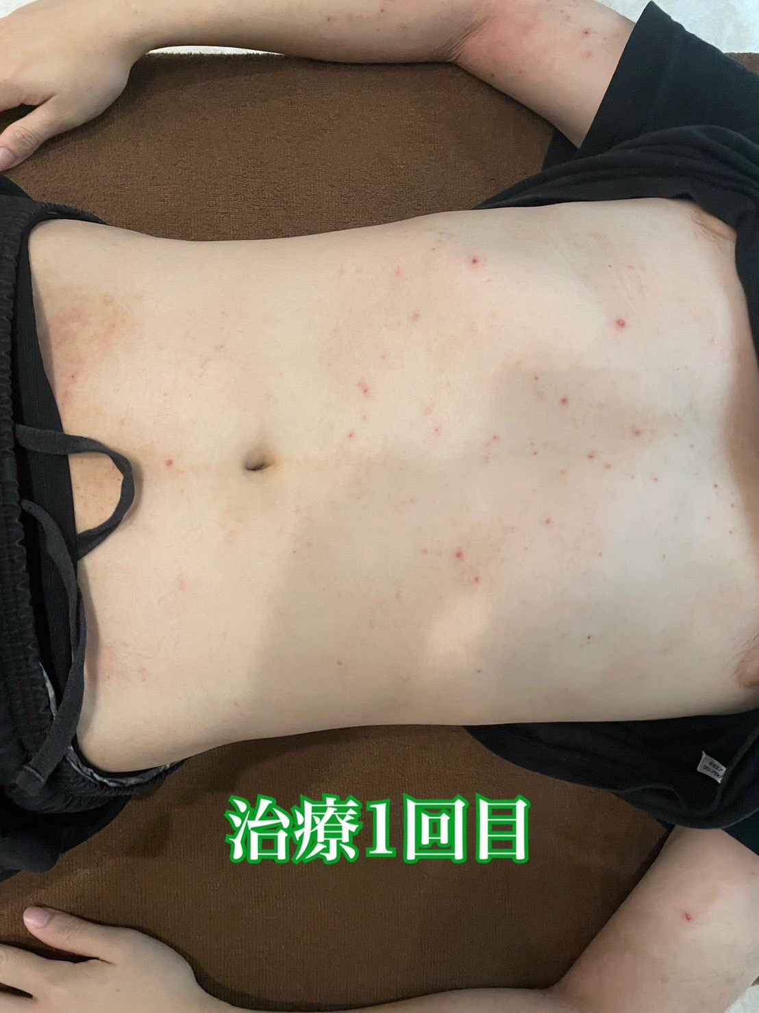 １回目施術前のアトピー患者様のお腹の写真