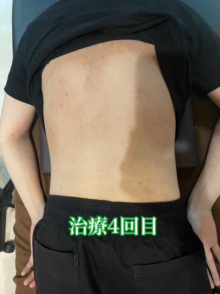4回目施術前のアトピー患者様の背中の写真